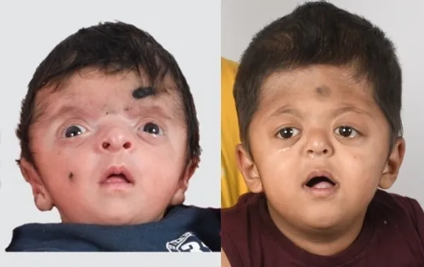 Apert syndrome illustration