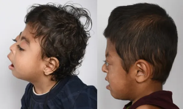 Bicoronal craniosynostosis illustration