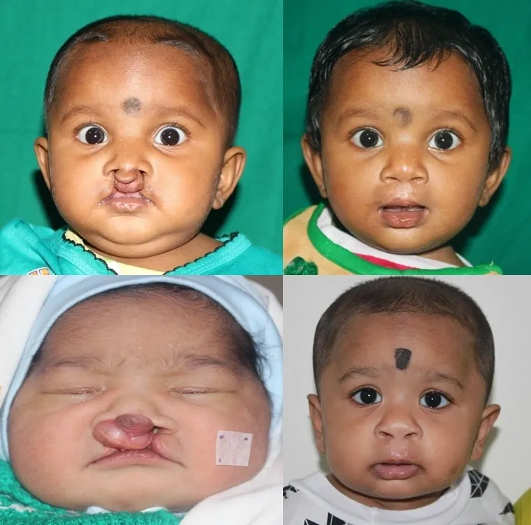 Bilateral cleft lip illustration
