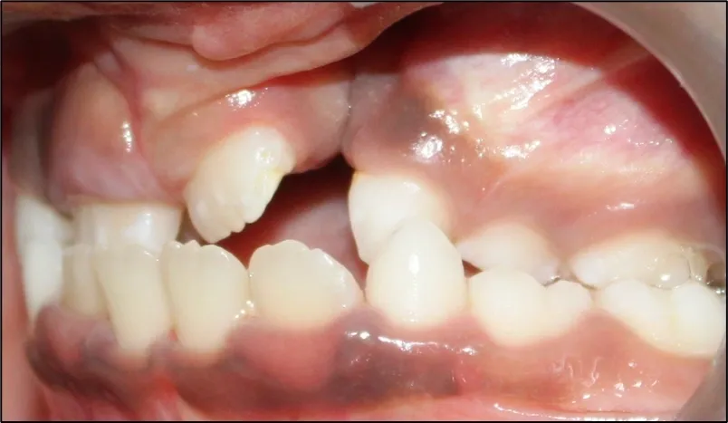 Cleft alveolus illustration