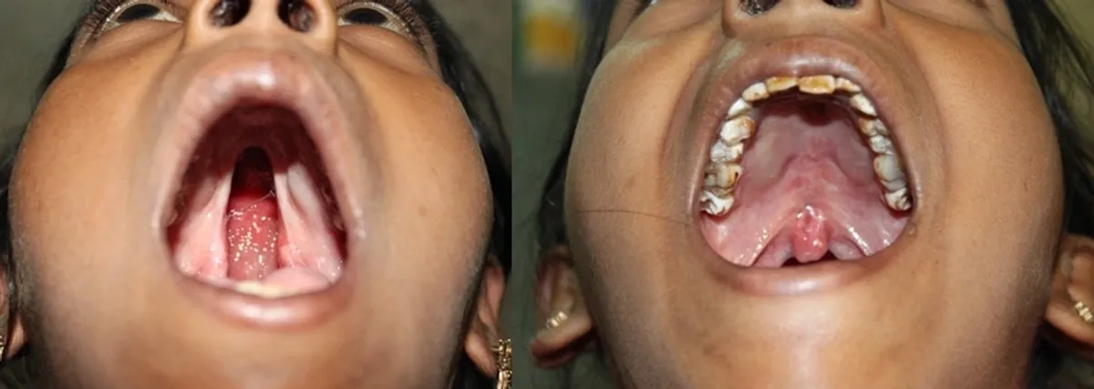 Cleft palate illustration