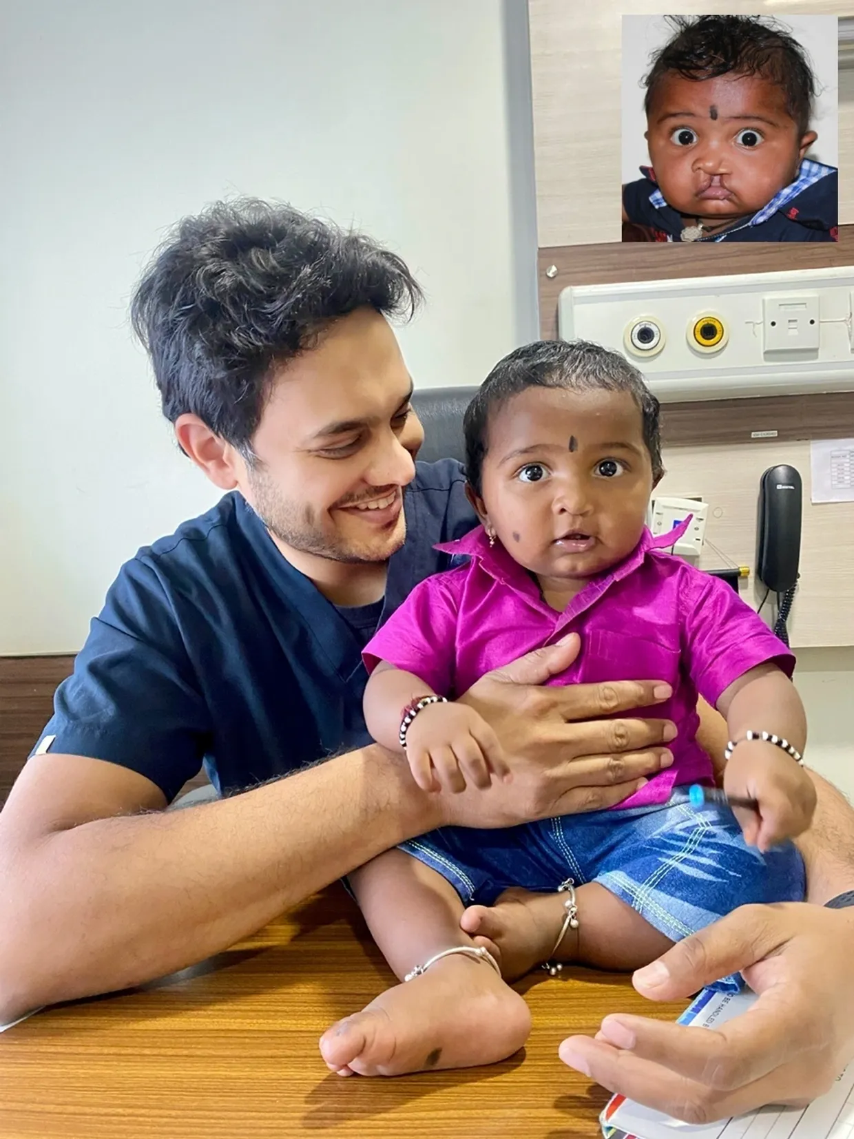 Cleft lip and palate surgery care in Bengaluru by Dr Dipesh Rao