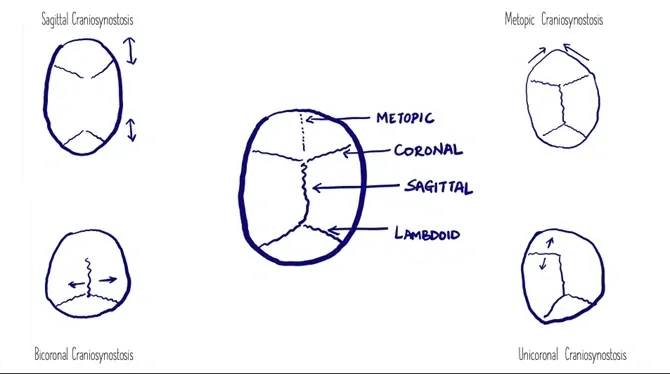 Craniosynostosis illustration