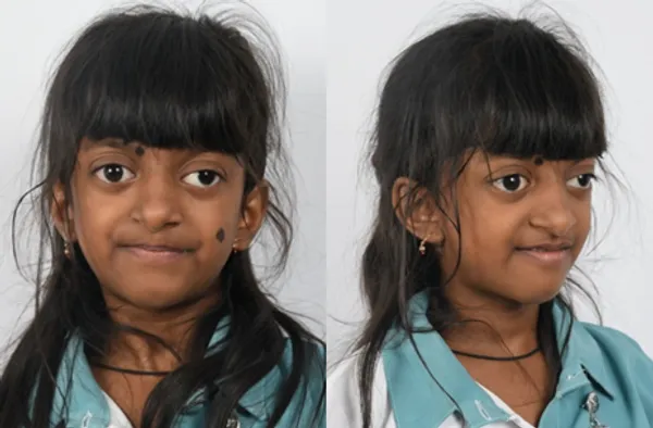 Crouzon syndrome illustration