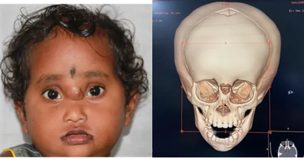 Encephalocele illustration
