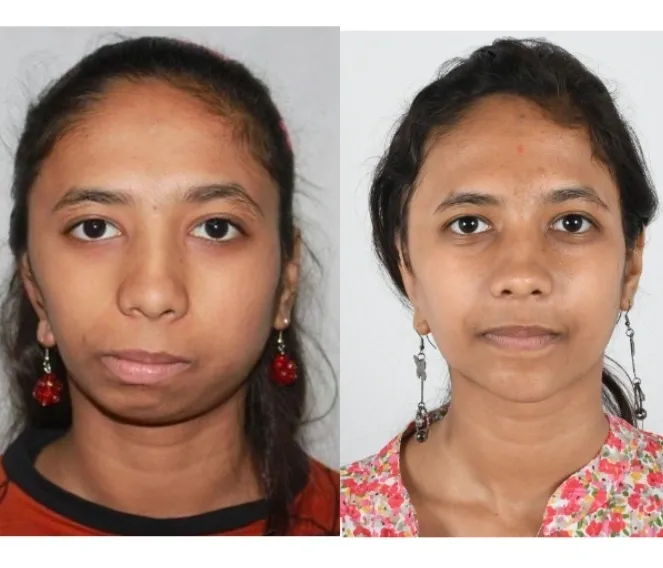 Facial asymmetry illustration