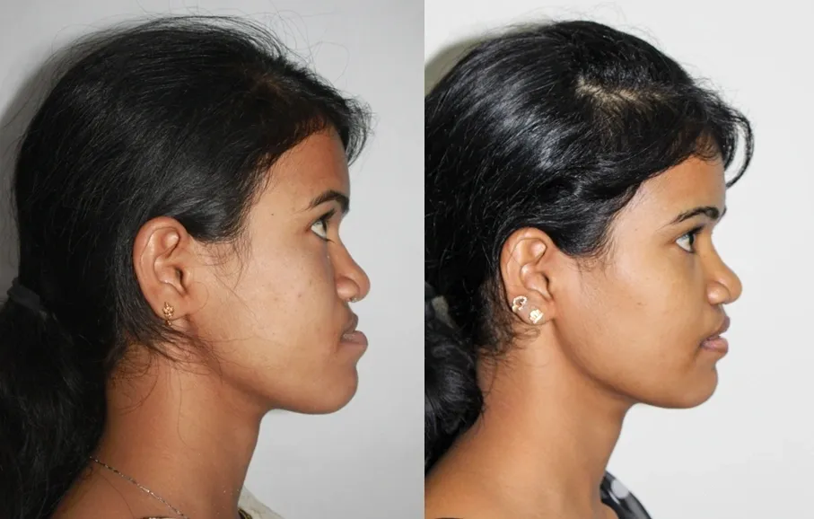 Maxillary hypoplasia illustration
