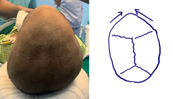 Metopic craniosynostosis illustration