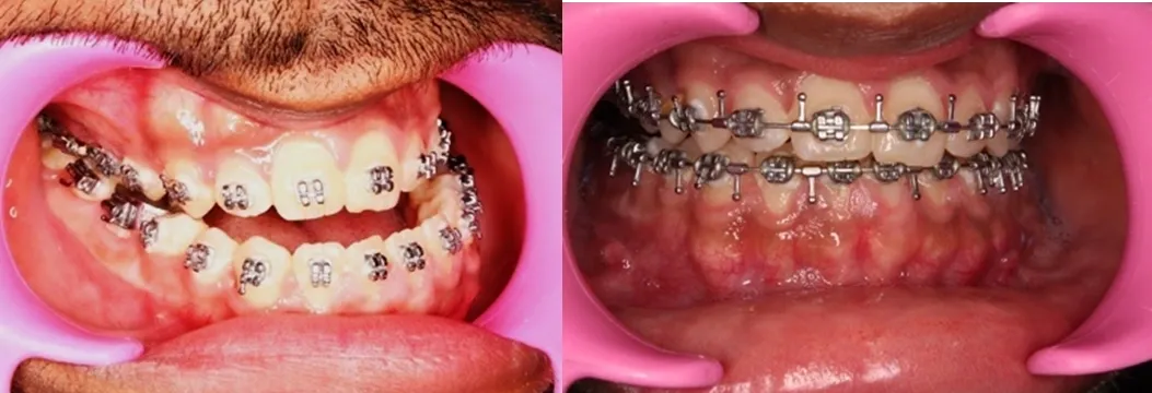 Open bite illustration