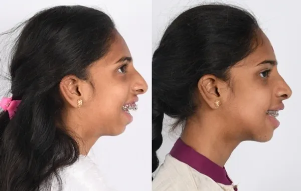 Overbite, severe Class II malocclusion illustration