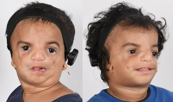 Treacher Collins syndrome illustration