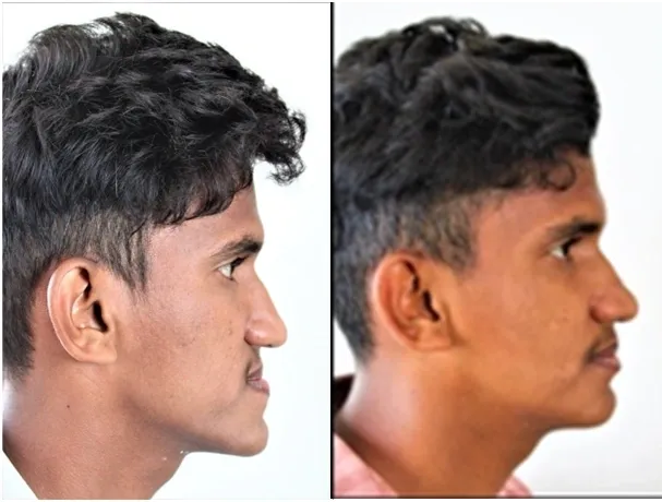 Underbite, severe Class III malocclusion illustration