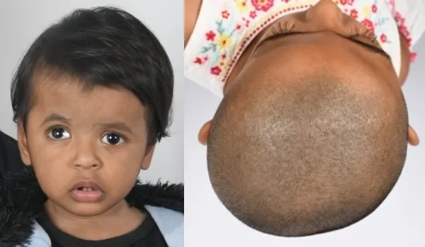 Unicoronal craniosynostosis illustration
