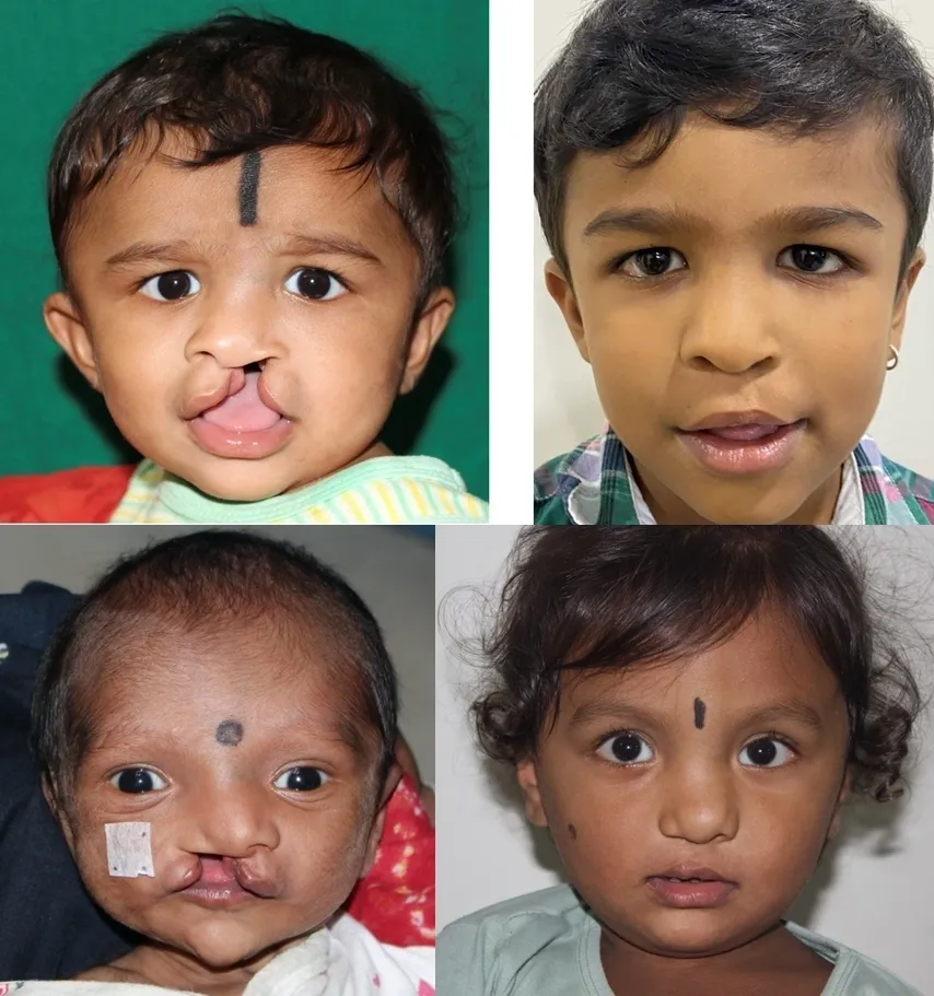 Unilateral cleft lip illustration
